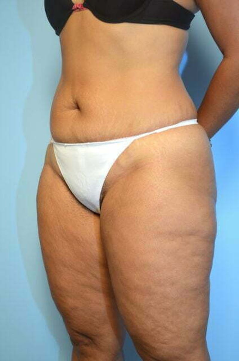 Umbilical Float Tummy Tuck Before & After Gallery - Patient 217291 - Image 7