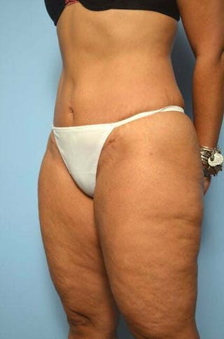 Umbilical Float Tummy Tuck Before & After Gallery - Patient 217291 - Image 8