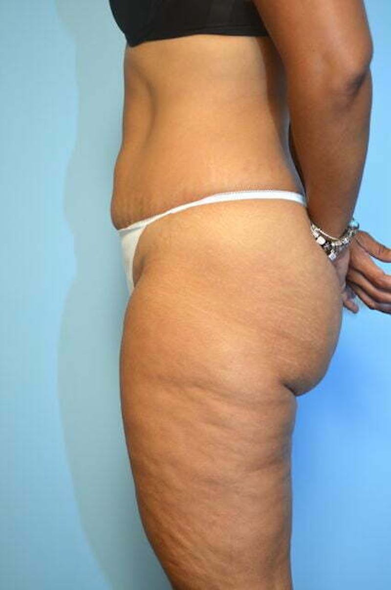 Umbilical Float Tummy Tuck Before & After Gallery - Patient 217291 - Image 9
