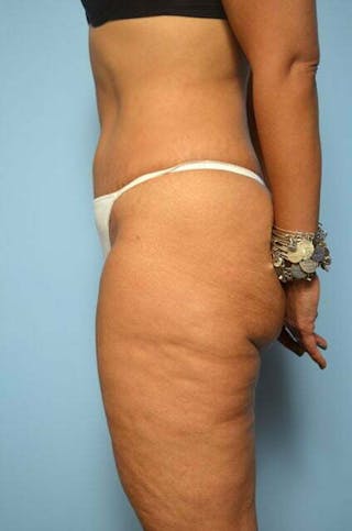 Umbilical Float Tummy Tuck Before & After Gallery - Patient 217291 - Image 10