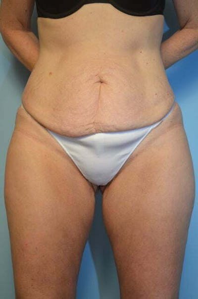 Liposuction Before & After Gallery - Patient 153622 - Image 1