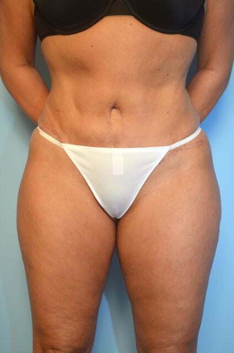 Umbilical Float Tummy Tuck Before & After Gallery - Patient 327240 - Image 2