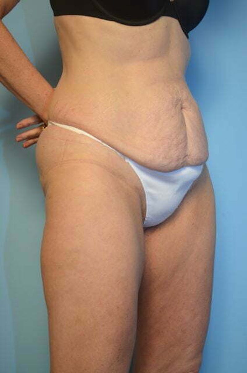 Umbilical Float Tummy Tuck Before & After Gallery - Patient 327240 - Image 3