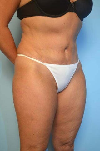 Liposuction Before & After Gallery - Patient 153622 - Image 4
