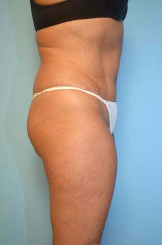 Liposuction Before & After Gallery - Patient 153622 - Image 6