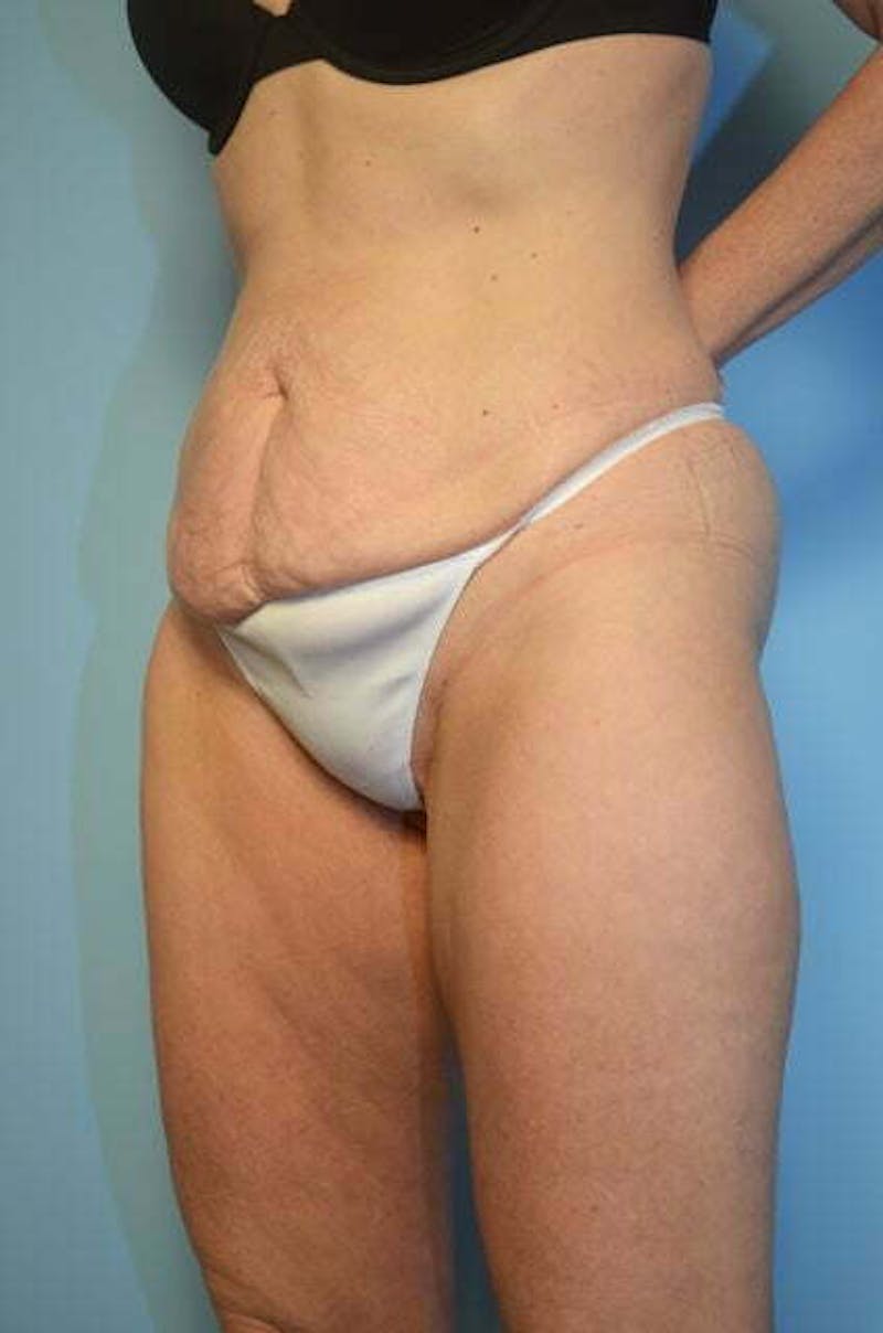 Umbilical Float Tummy Tuck Before & After Gallery - Patient 327240 - Image 7