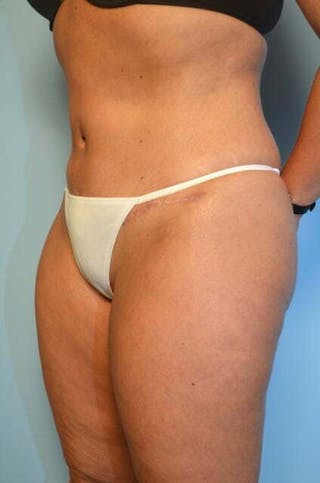 Liposuction Before & After Gallery - Patient 153622 - Image 8