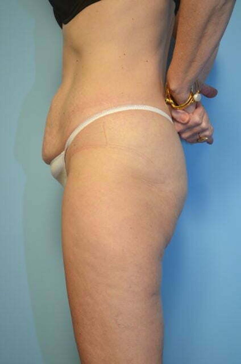 Umbilical Float Tummy Tuck Before & After Gallery - Patient 327240 - Image 9