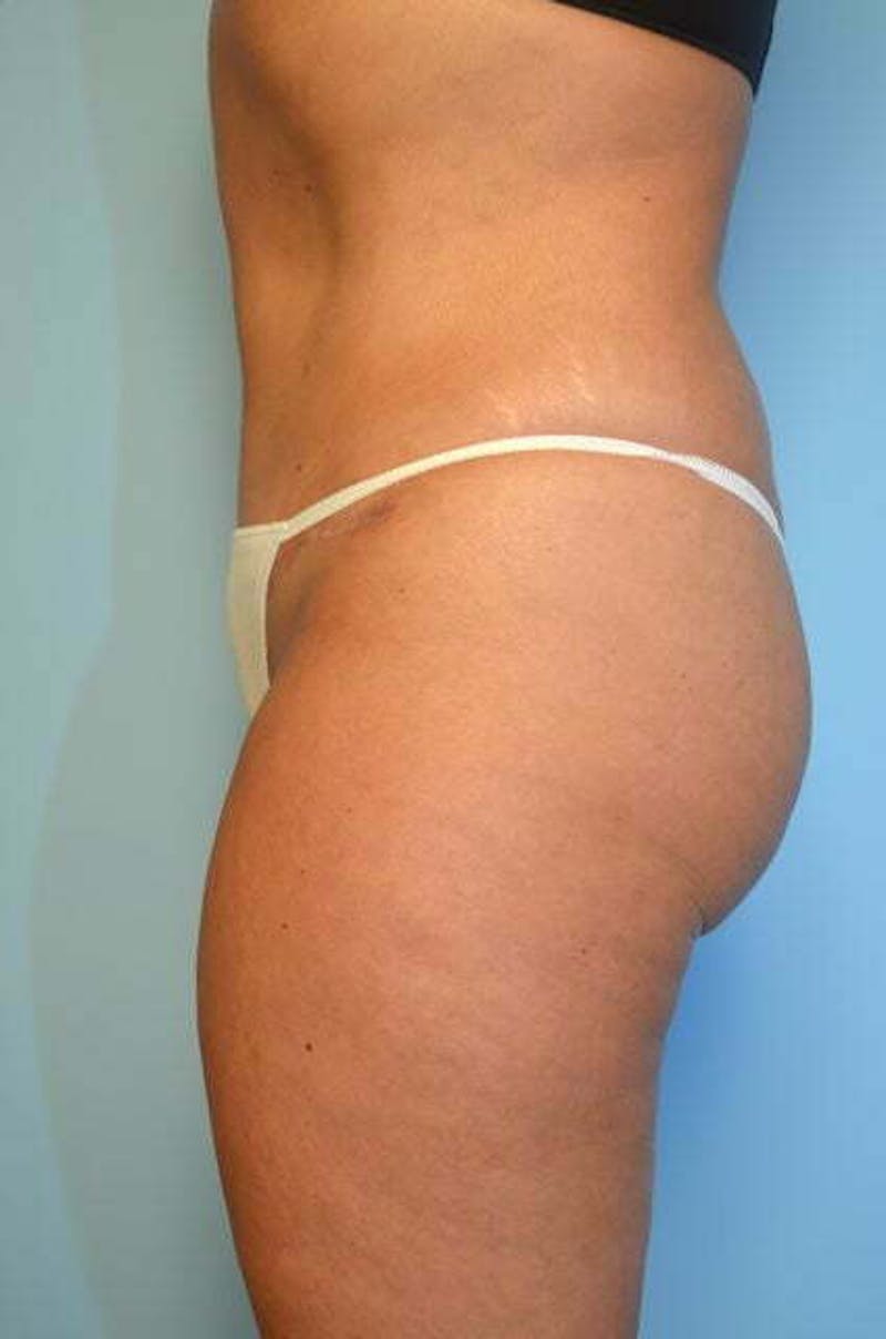 Umbilical Float Tummy Tuck Before & After Gallery - Patient 327240 - Image 10