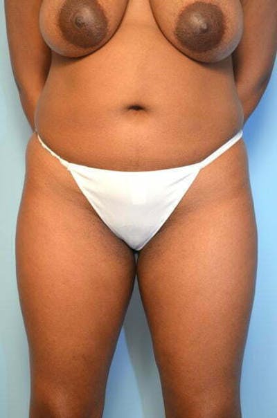 Liposuction Before & After Gallery - Patient 317561 - Image 1
