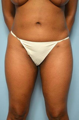 Liposuction Before & After Gallery - Patient 317561 - Image 2