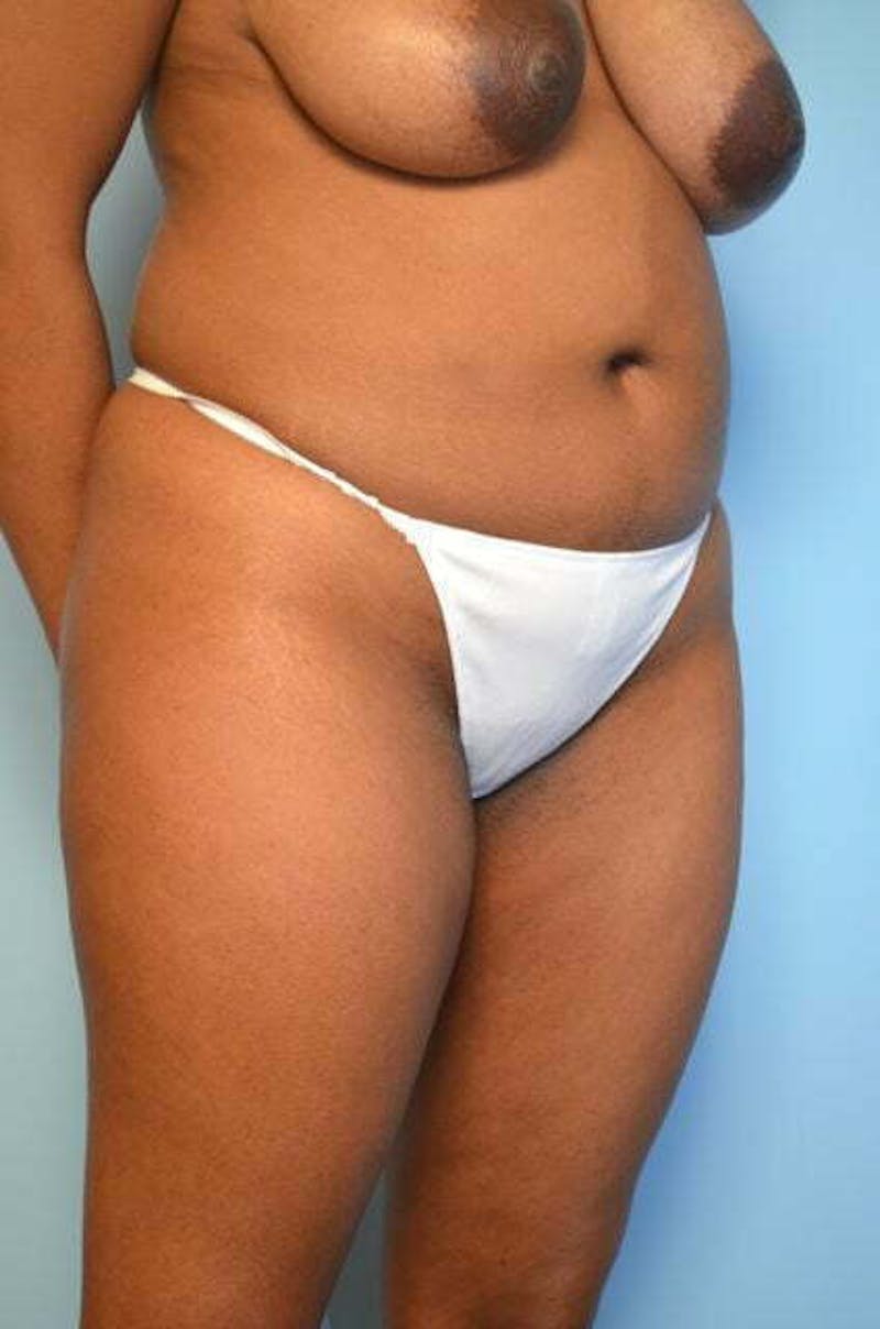 Liposuction Before & After Gallery - Patient 317561 - Image 3