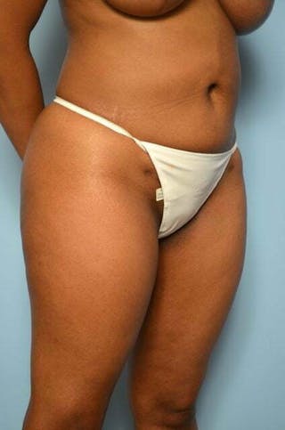 Liposuction Before & After Gallery - Patient 317561 - Image 4
