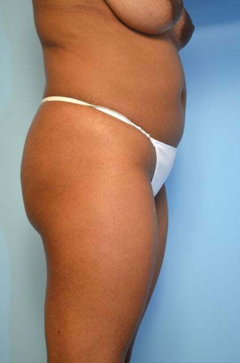 Liposuction Before & After Gallery - Patient 317561 - Image 5