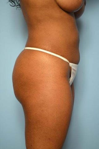 Liposuction Before & After Gallery - Patient 317561 - Image 6