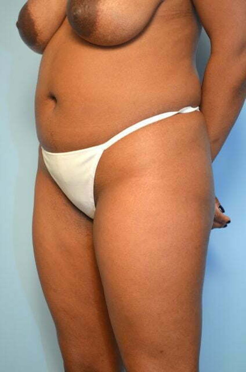 Liposuction Before & After Gallery - Patient 317561 - Image 7