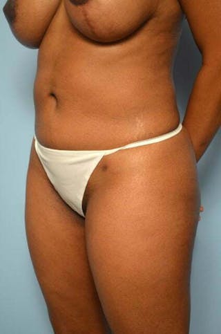 Liposuction Before & After Gallery - Patient 317561 - Image 8
