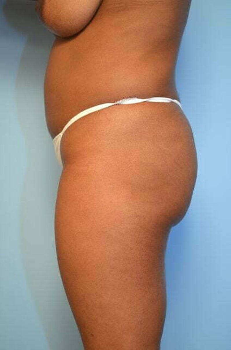 Liposuction Before & After Gallery - Patient 317561 - Image 9