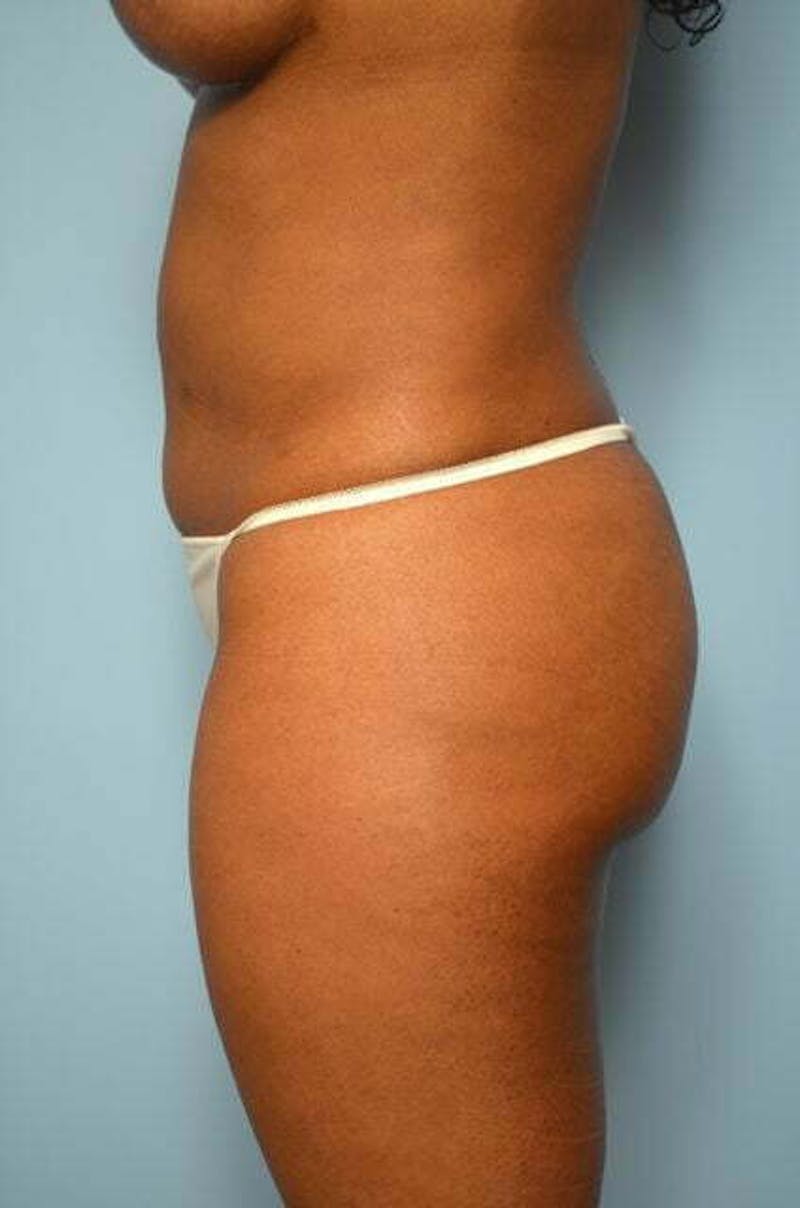 Liposuction Before & After Gallery - Patient 317561 - Image 10