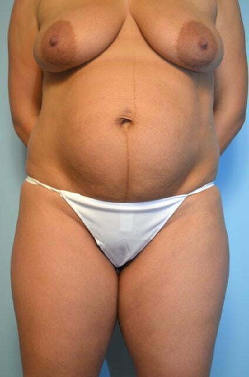 Umbilical Float Tummy Tuck Before & After Gallery - Patient 116018 - Image 1