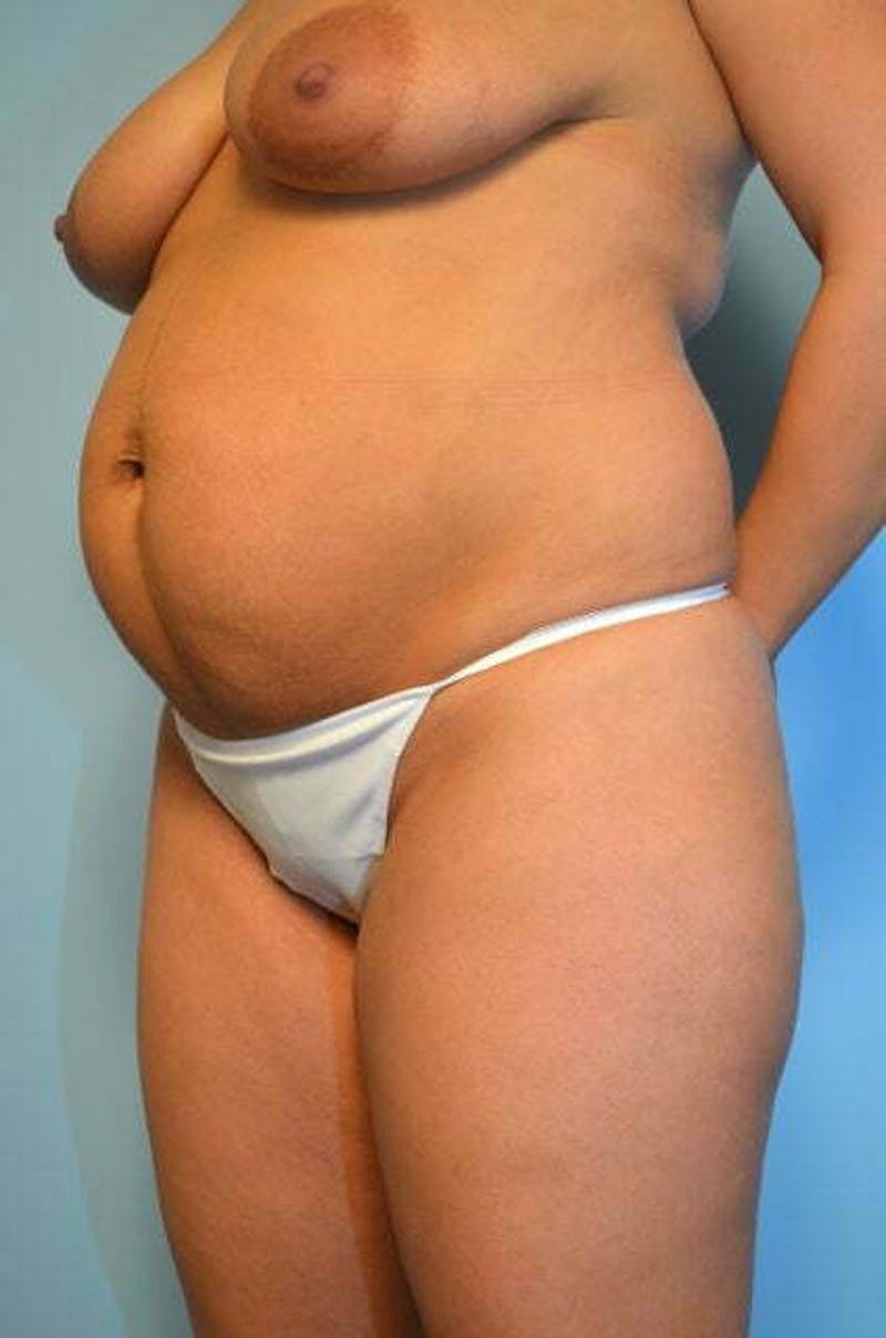 Umbilical Float Tummy Tuck Before & After Gallery - Patient 116018 - Image 7