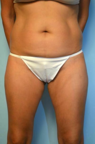 Umbilical Float Tummy Tuck Before & After Gallery - Patient 423609 - Image 1