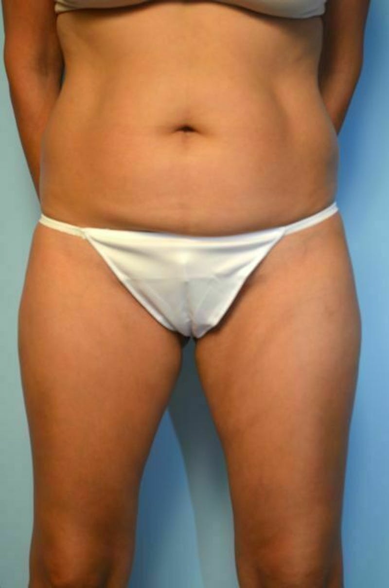 Umbilical Float Tummy Tuck Before & After Gallery - Patient 423609 - Image 1