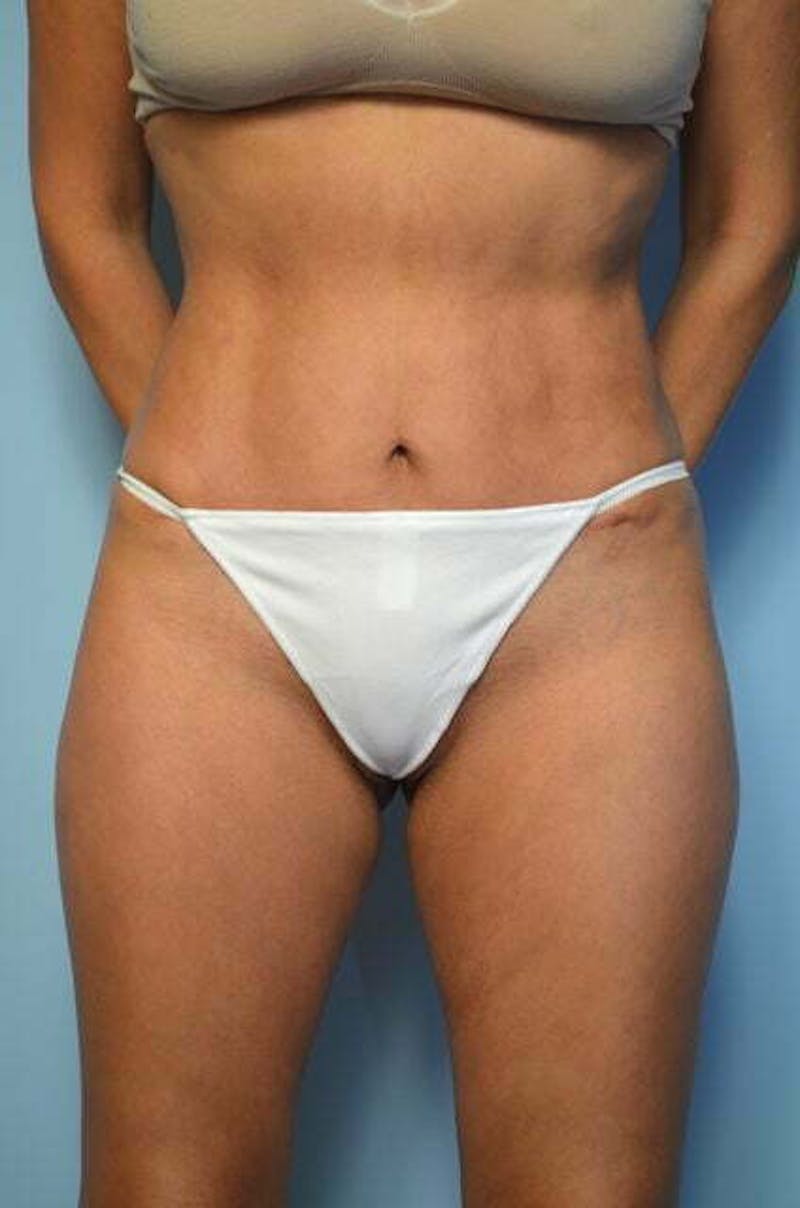 Umbilical Float Tummy Tuck Before & After Gallery - Patient 423609 - Image 2