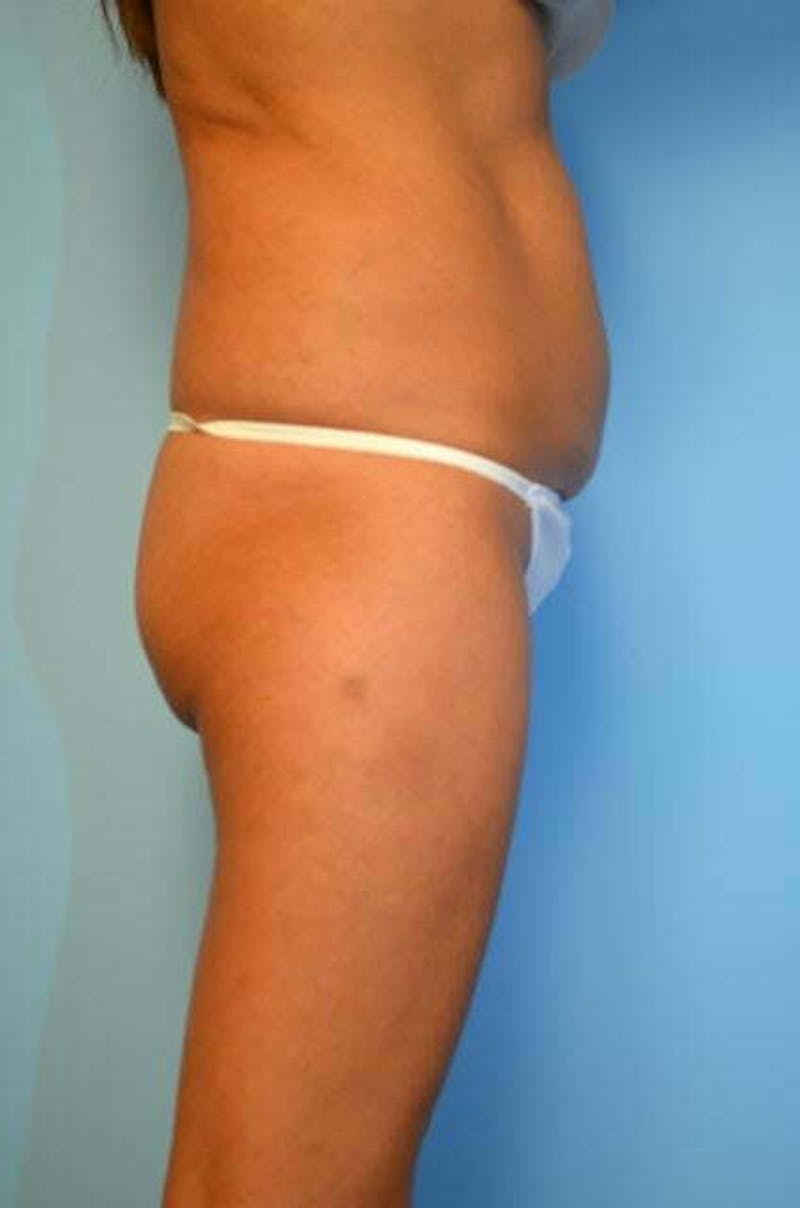 Umbilical Float Tummy Tuck Before & After Gallery - Patient 423609 - Image 5