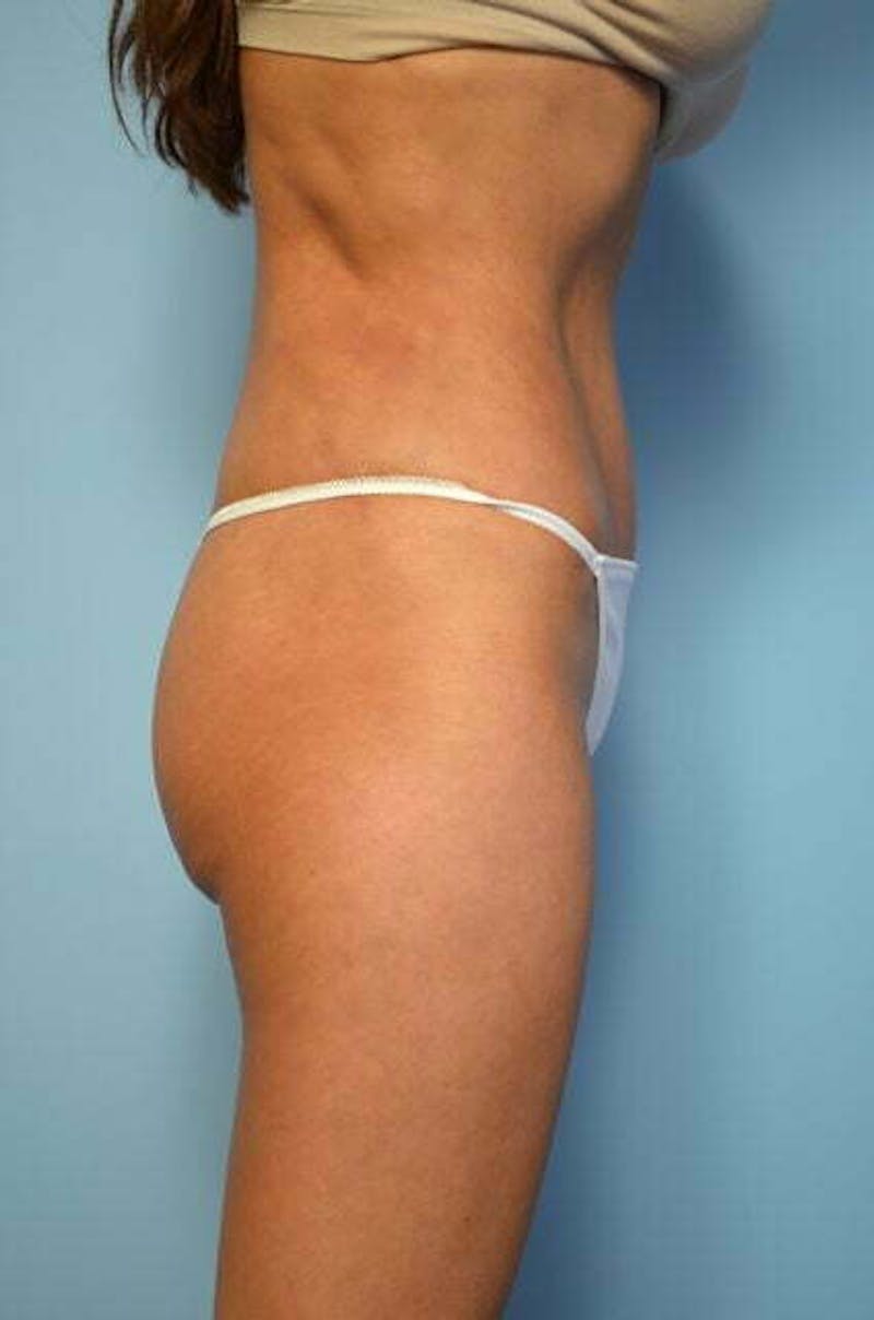 Umbilical Float Tummy Tuck Before & After Gallery - Patient 423609 - Image 6