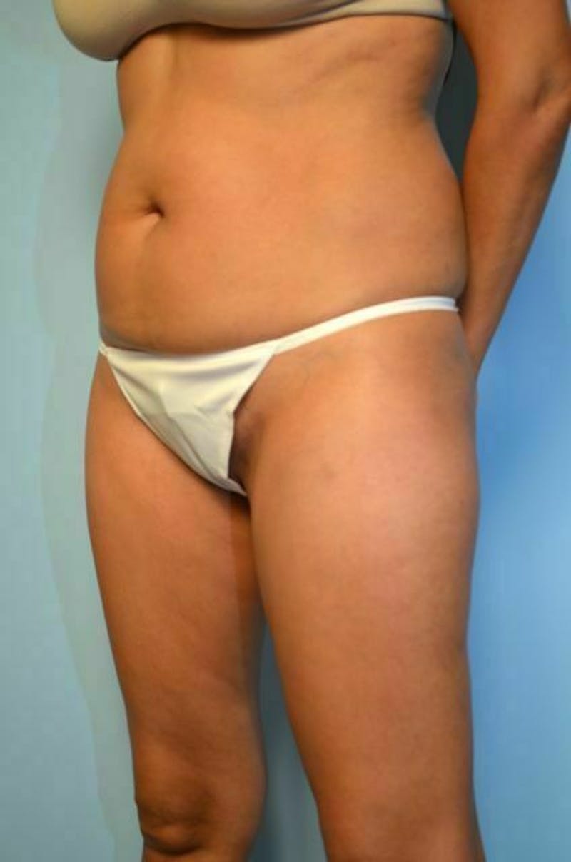 Umbilical Float Tummy Tuck Before & After Gallery - Patient 423609 - Image 7
