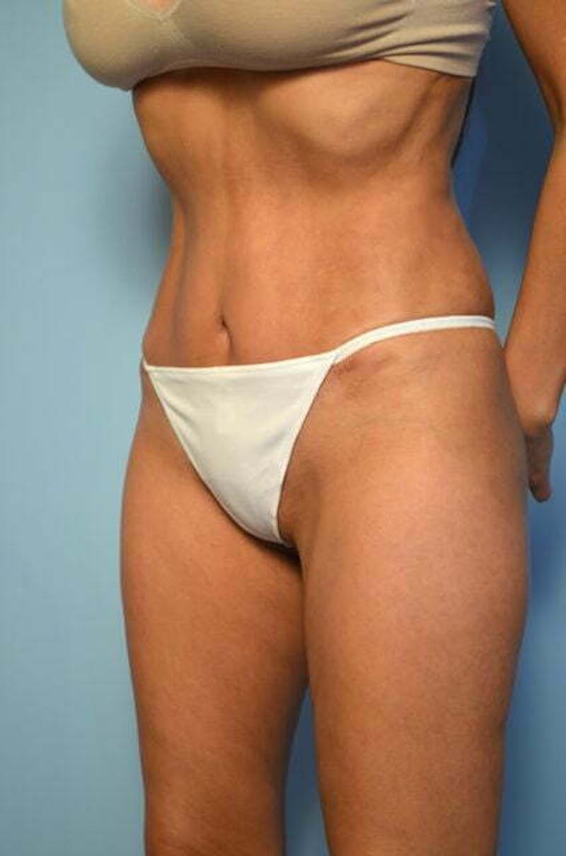 Umbilical Float Tummy Tuck Before & After Gallery - Patient 423609 - Image 8