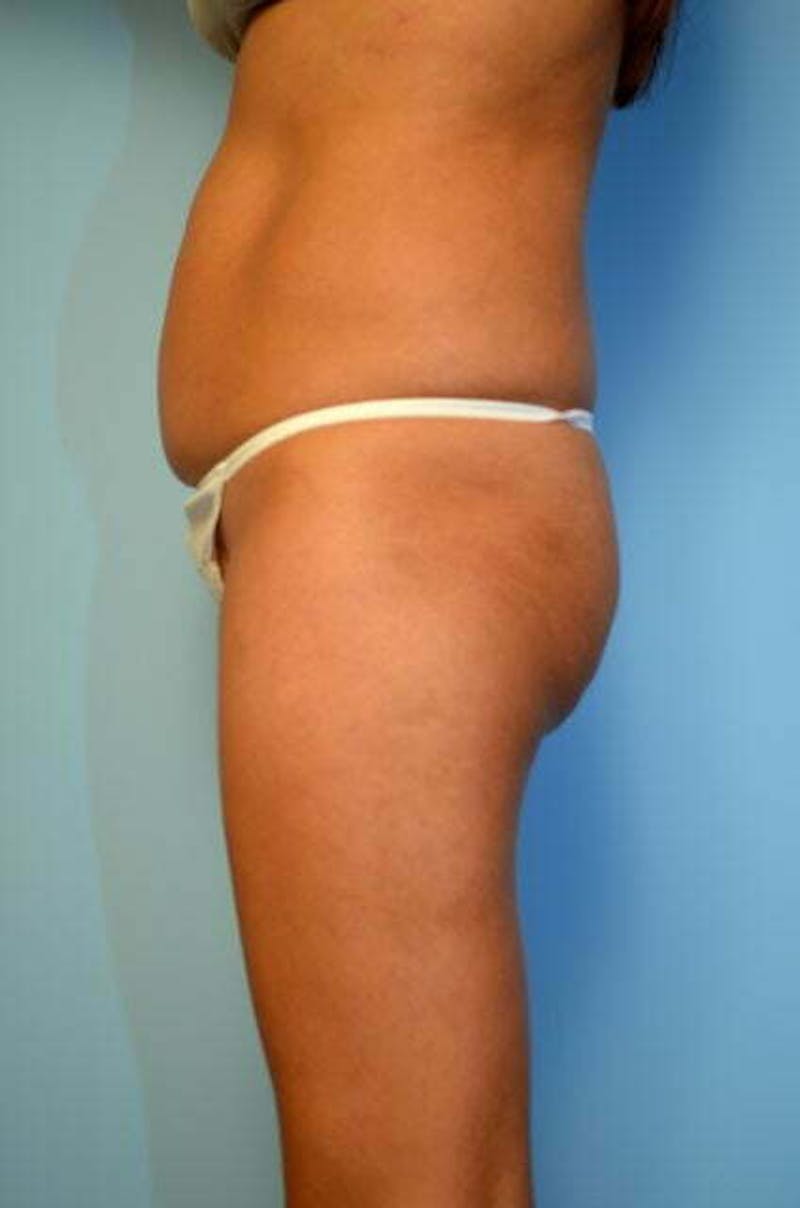 Umbilical Float Tummy Tuck Before & After Gallery - Patient 423609 - Image 9