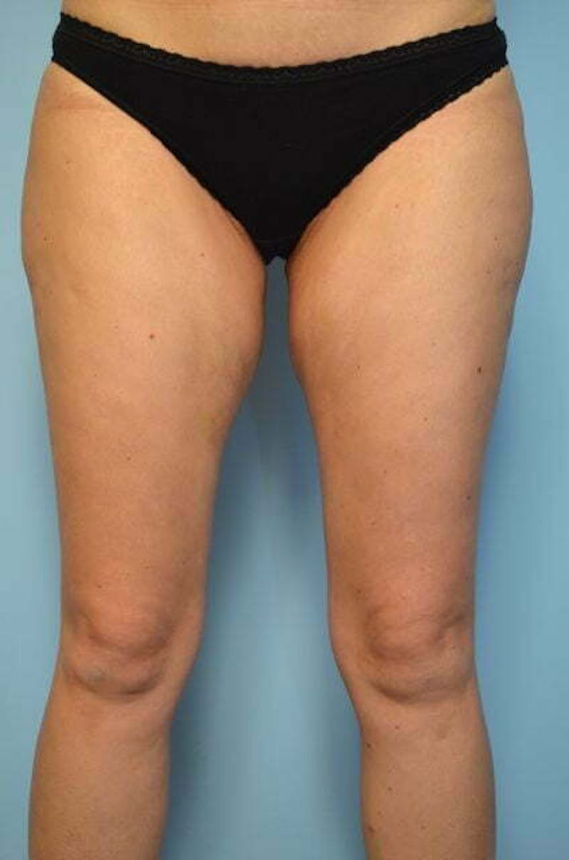 Liposuction Before & After Gallery - Patient 405291 - Image 1