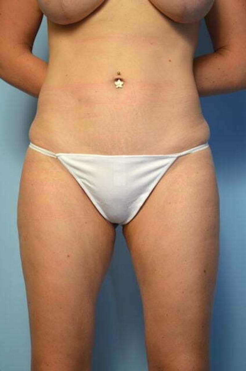 Liposuction Before & After Gallery - Patient 405291 - Image 2