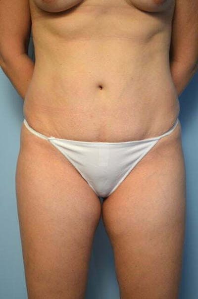 Liposuction Before & After Gallery - Patient 753468 - Image 1