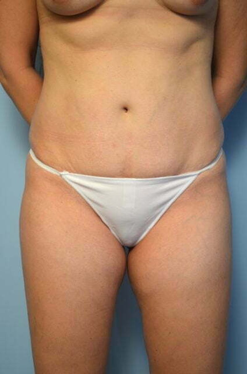 Liposuction Before & After Gallery - Patient 753468 - Image 1