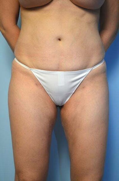 Liposuction Before & After Gallery - Patient 753468 - Image 2