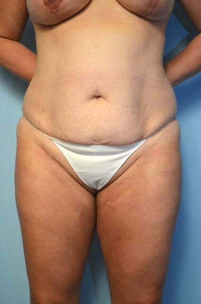 Liposuction Before & After Gallery - Patient 358685 - Image 1
