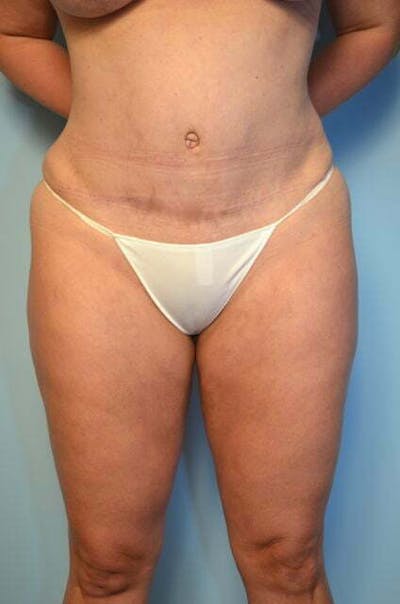 Liposuction Before & After Gallery - Patient 358685 - Image 2