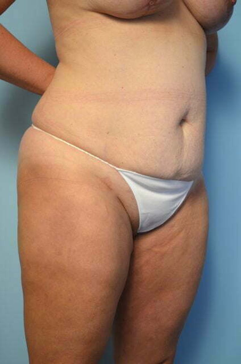Liposuction Before & After Gallery - Patient 358685 - Image 3