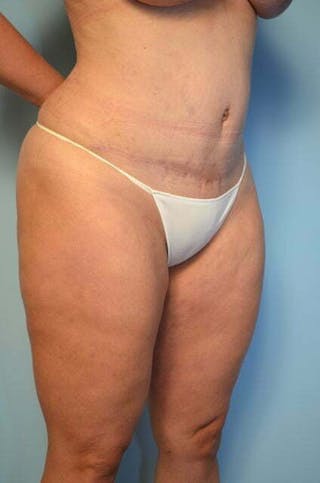 Liposuction Before & After Gallery - Patient 358685 - Image 4