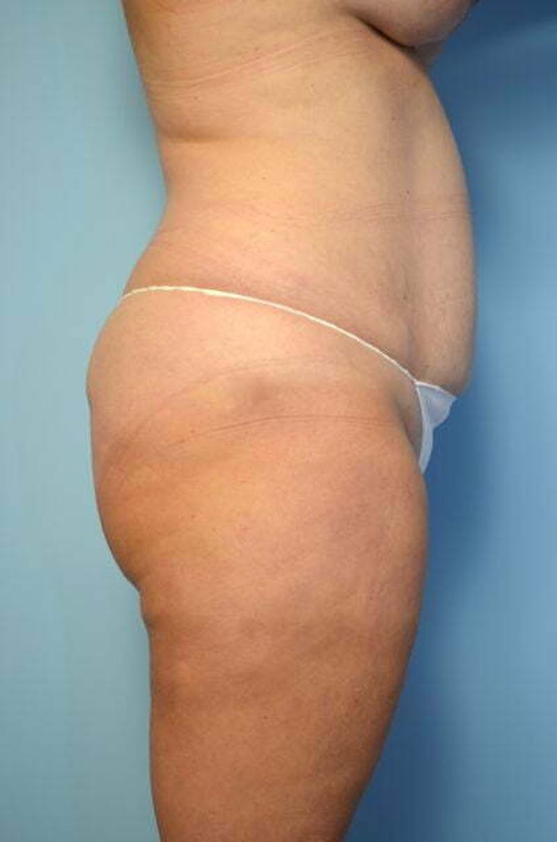 Liposuction Before & After Gallery - Patient 358685 - Image 5