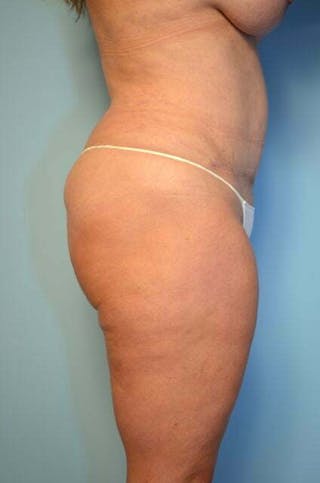 Liposuction Before & After Gallery - Patient 358685 - Image 6