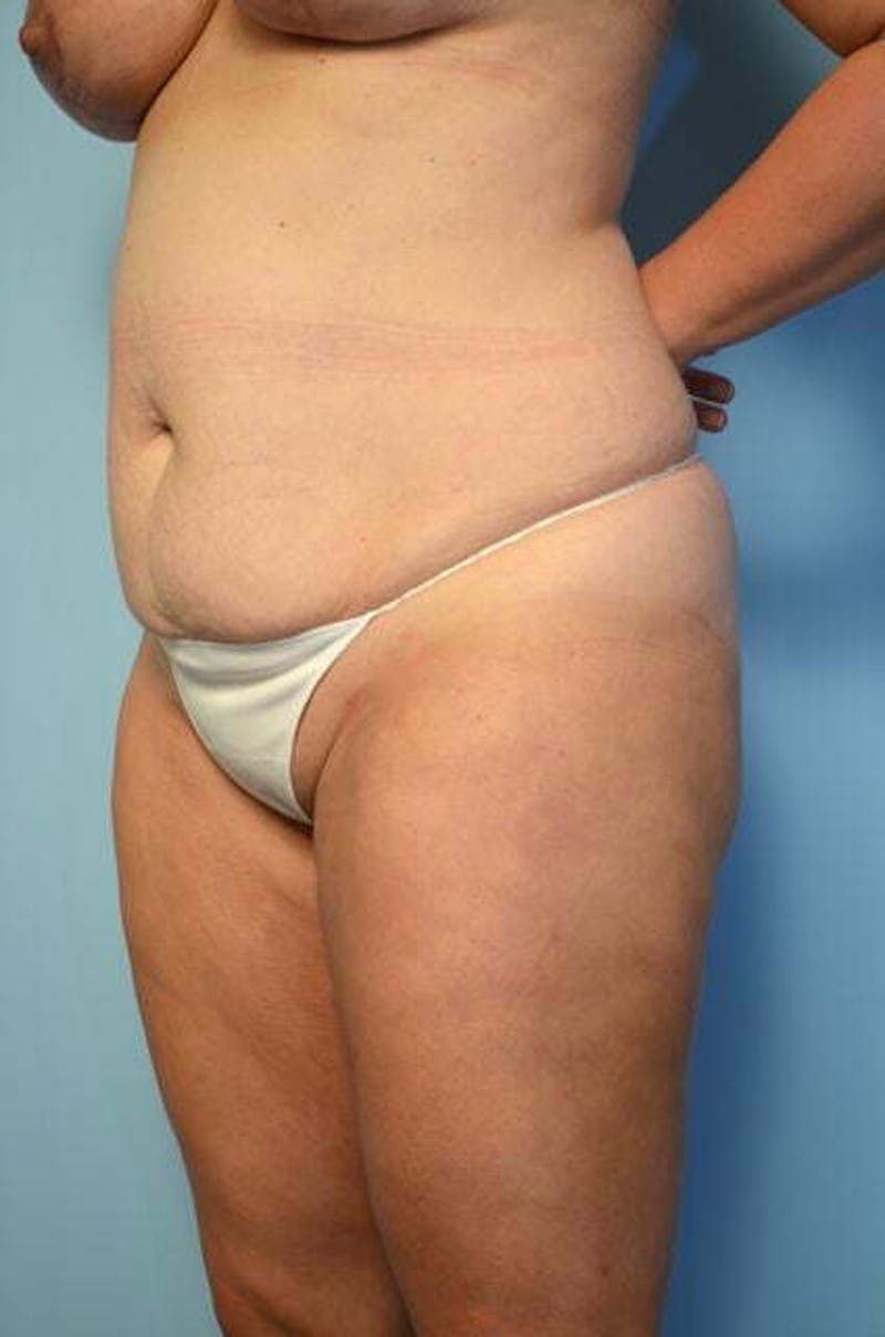 Liposuction Before & After Gallery - Patient 358685 - Image 7