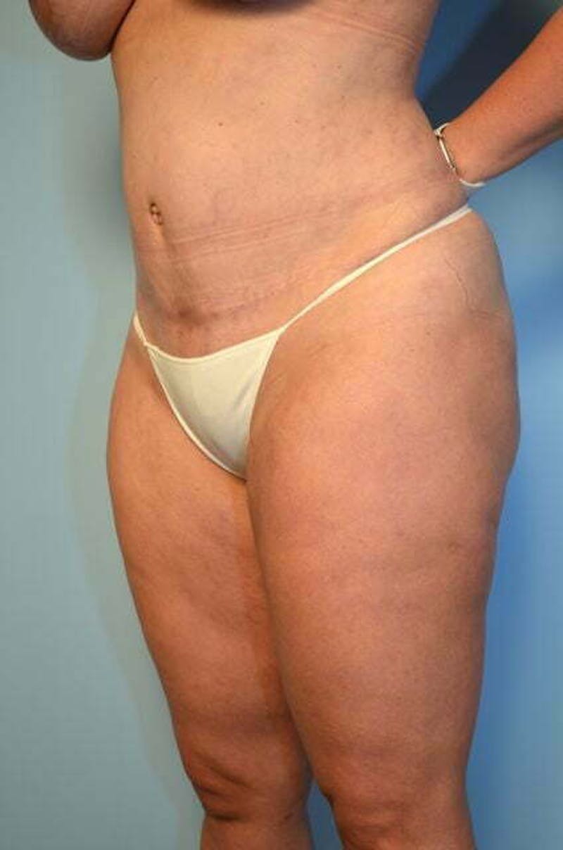 Liposuction Before & After Gallery - Patient 358685 - Image 8