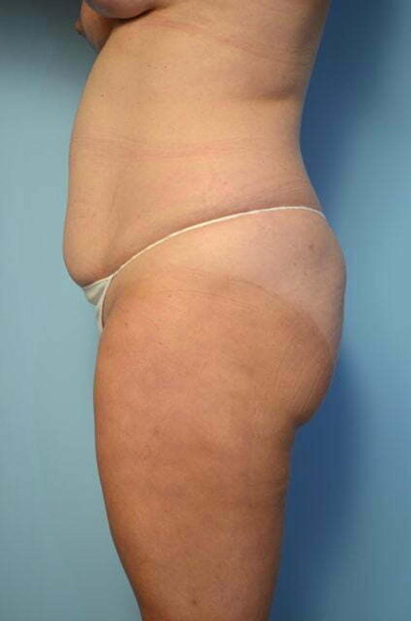Liposuction Before & After Gallery - Patient 358685 - Image 9