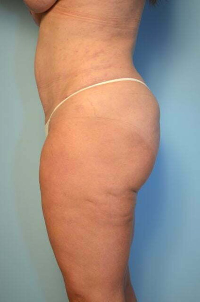 Liposuction Before & After Gallery - Patient 358685 - Image 10