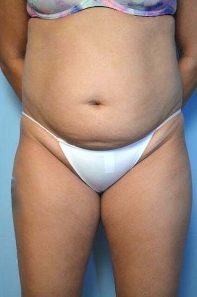 Liposuction Before & After Gallery - Patient 168913 - Image 1