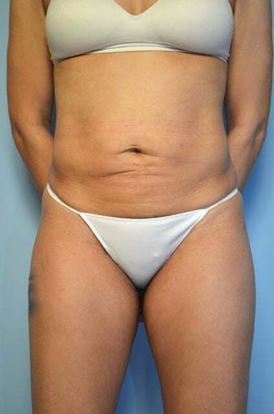 Liposuction Before & After Gallery - Patient 168913 - Image 2